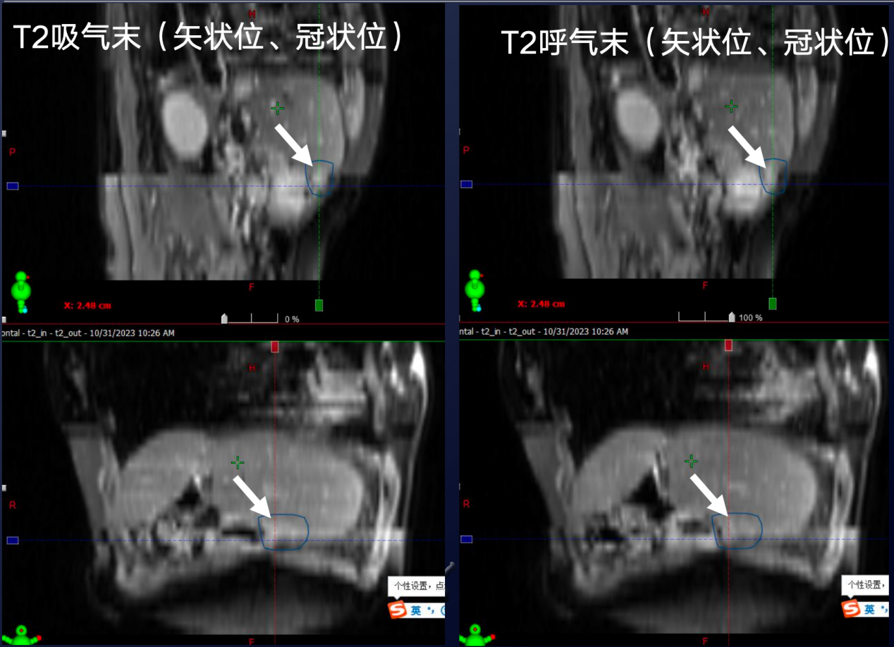 MR扫描的呼吸运动管理图像.png