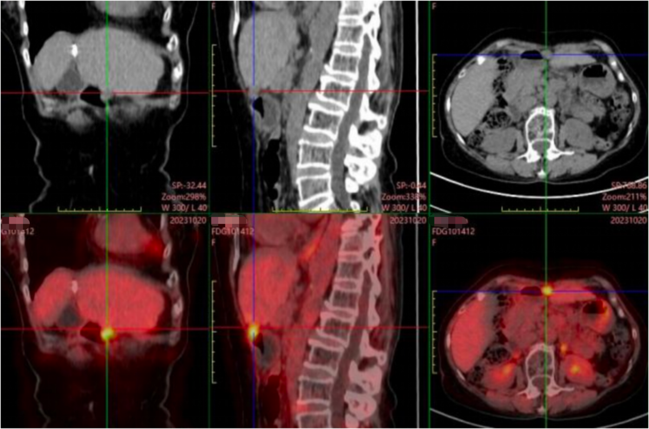 2023-10-20全身PET-CT扫描影像.png