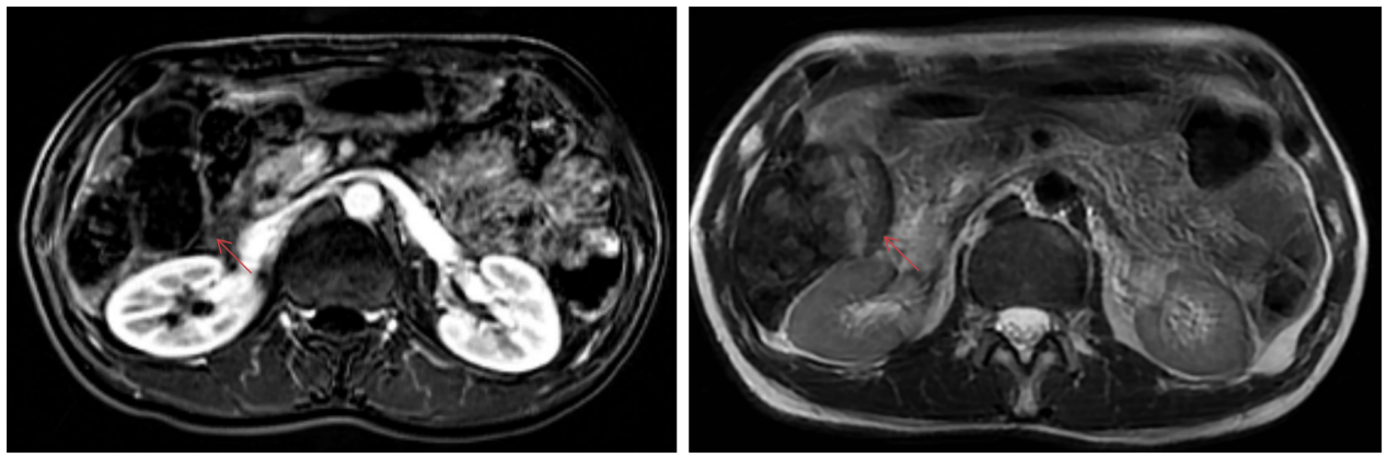2022-06-07上腹部MRI影像，对比前片提示PR.png