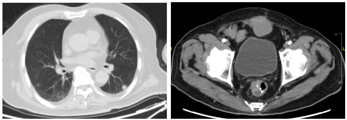 图2. CT检查(2023年2月28日).png 图2. CT检查(2023年2月28日).png