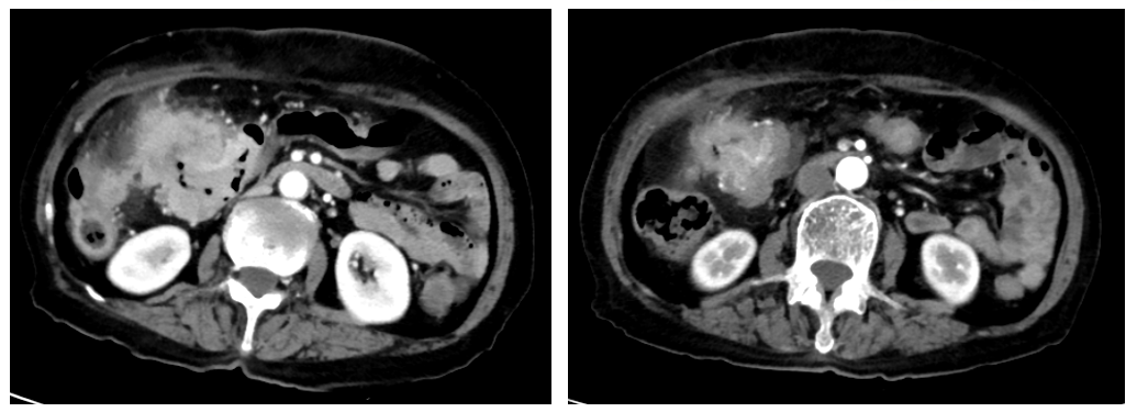 图5. 腹部CT检查(左:2022年6月23日;右:2022年8月23日).png 图5. 腹部CT检查(左:2022年6月23日;右:2022年8月23日).png
