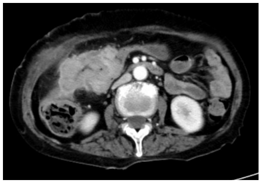 图4. 腹部CT(2022年6月25日).png 图4. 腹部CT(2022年6月25日).png