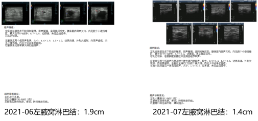 【张伟纯病例】双口服方案护航长生存！长春瑞滨节拍化疗联合吡咯替尼助力HER2阳性乳腺癌实现15个月PFS(1)1556.png