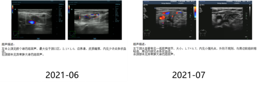 【张伟纯病例】双口服方案护航长生存！长春瑞滨节拍化疗联合吡咯替尼助力HER2阳性乳腺癌实现15个月PFS(1)1558.png