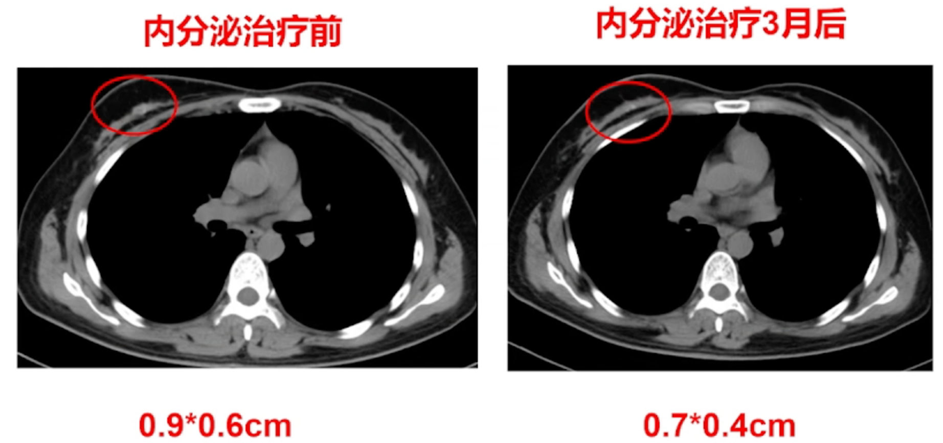 三线治疗后右乳病灶影像学检查.png