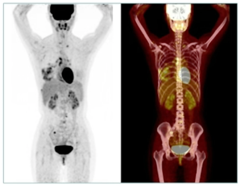 全身PET-CT.png