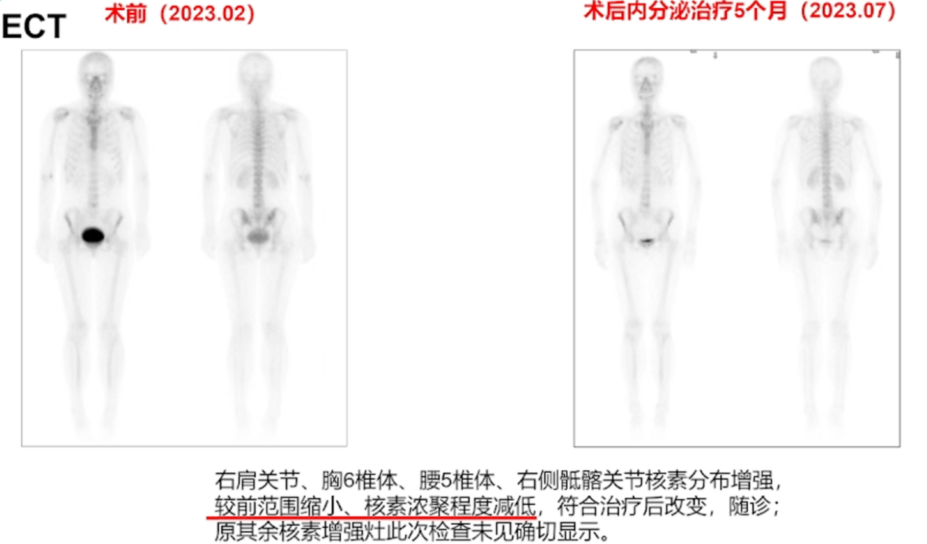 术后内分泌治疗5个月后ECT检查.png