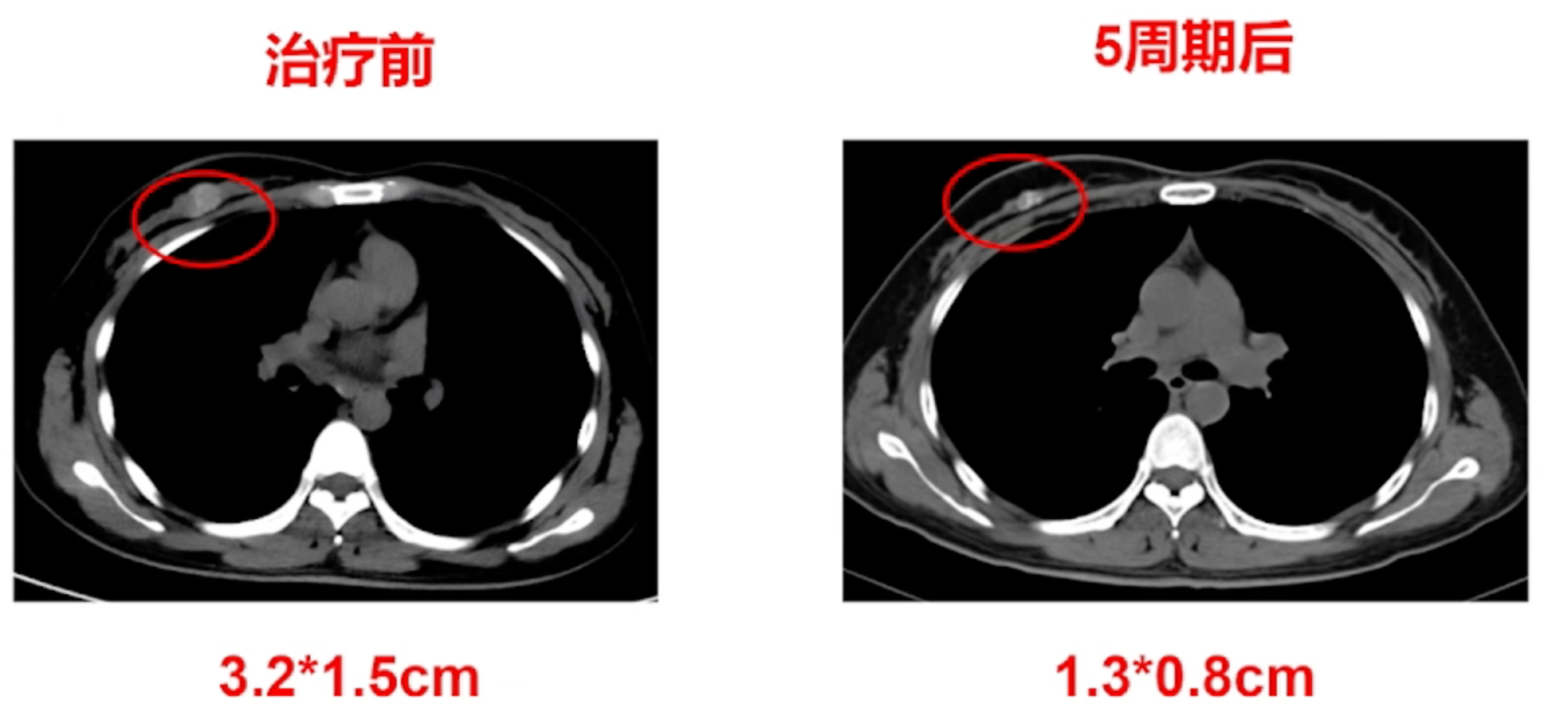 一线治疗后右乳病灶影像学检查.png
