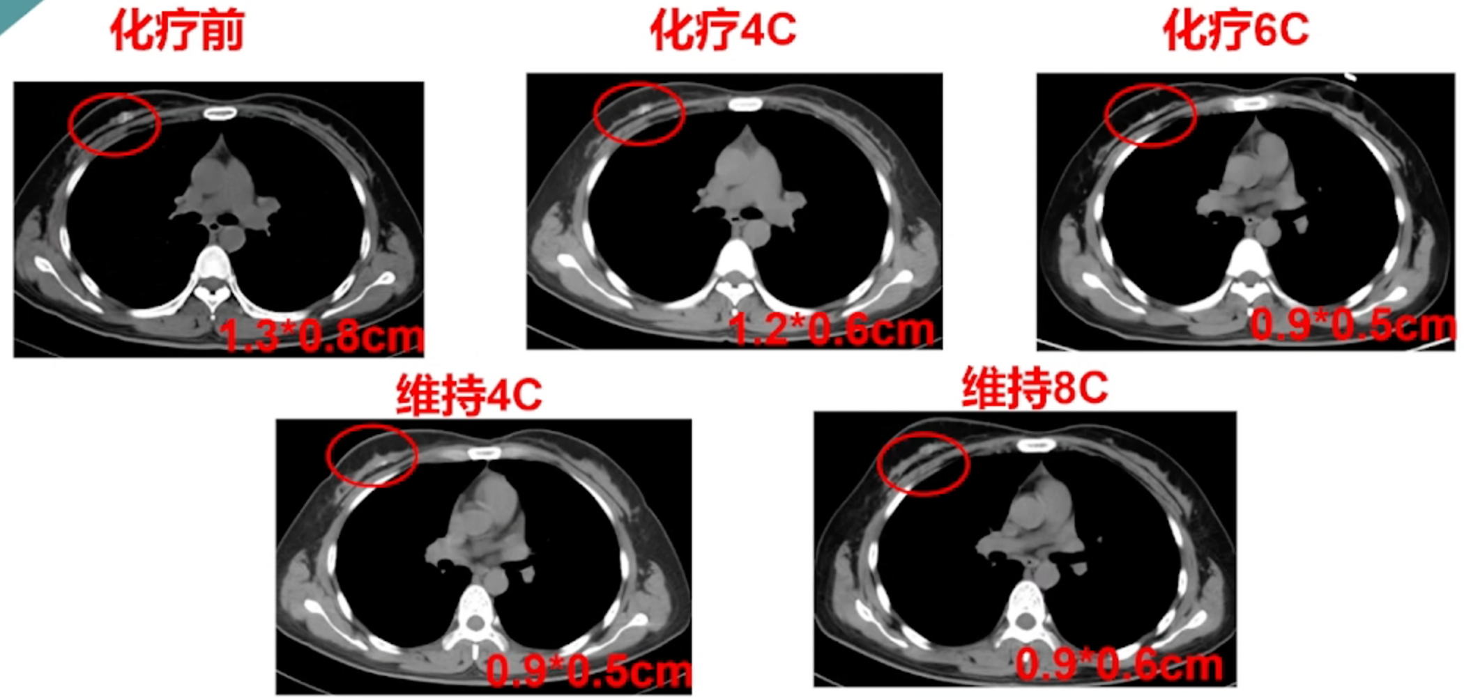 二线治疗后右乳病灶影像学检查.png