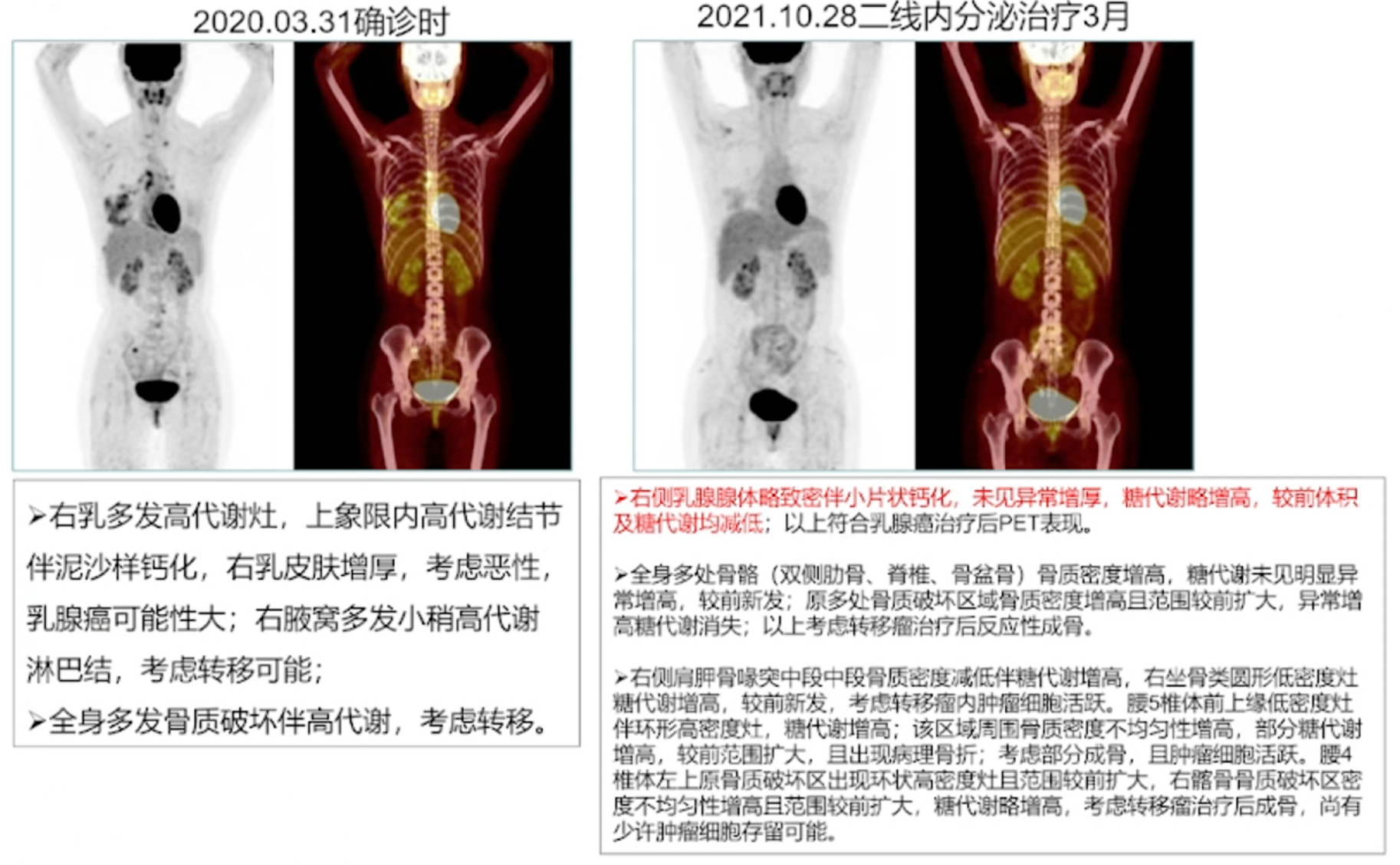 三线治疗后ECT检查.png