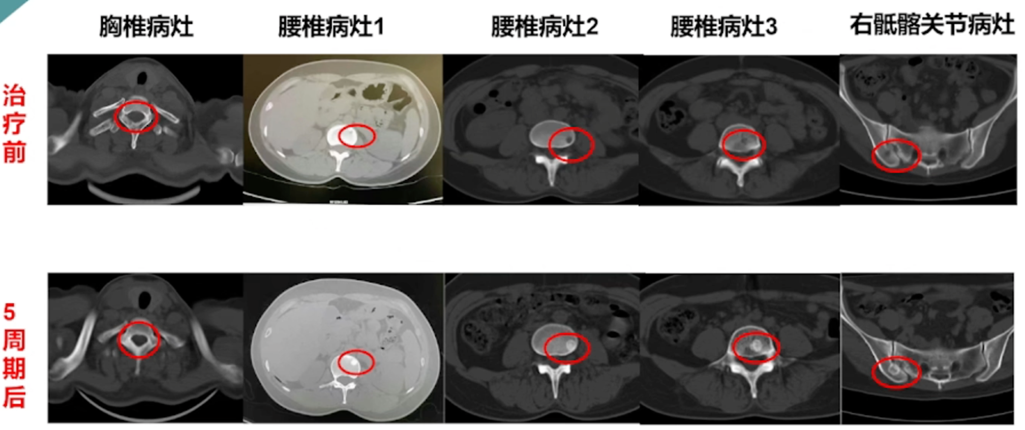 一线治疗后骨转移病灶检查.png