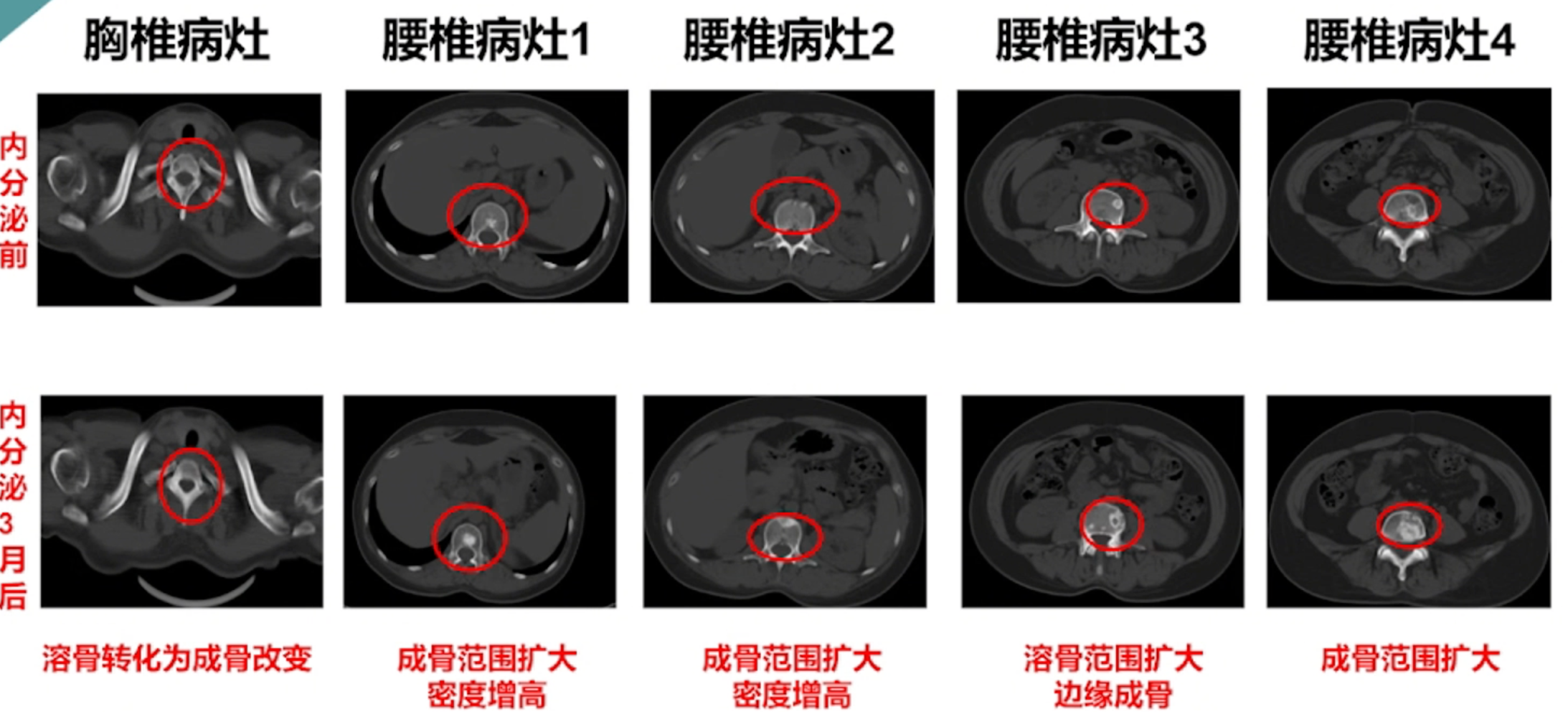 三线治疗后骨转移病灶检查.png