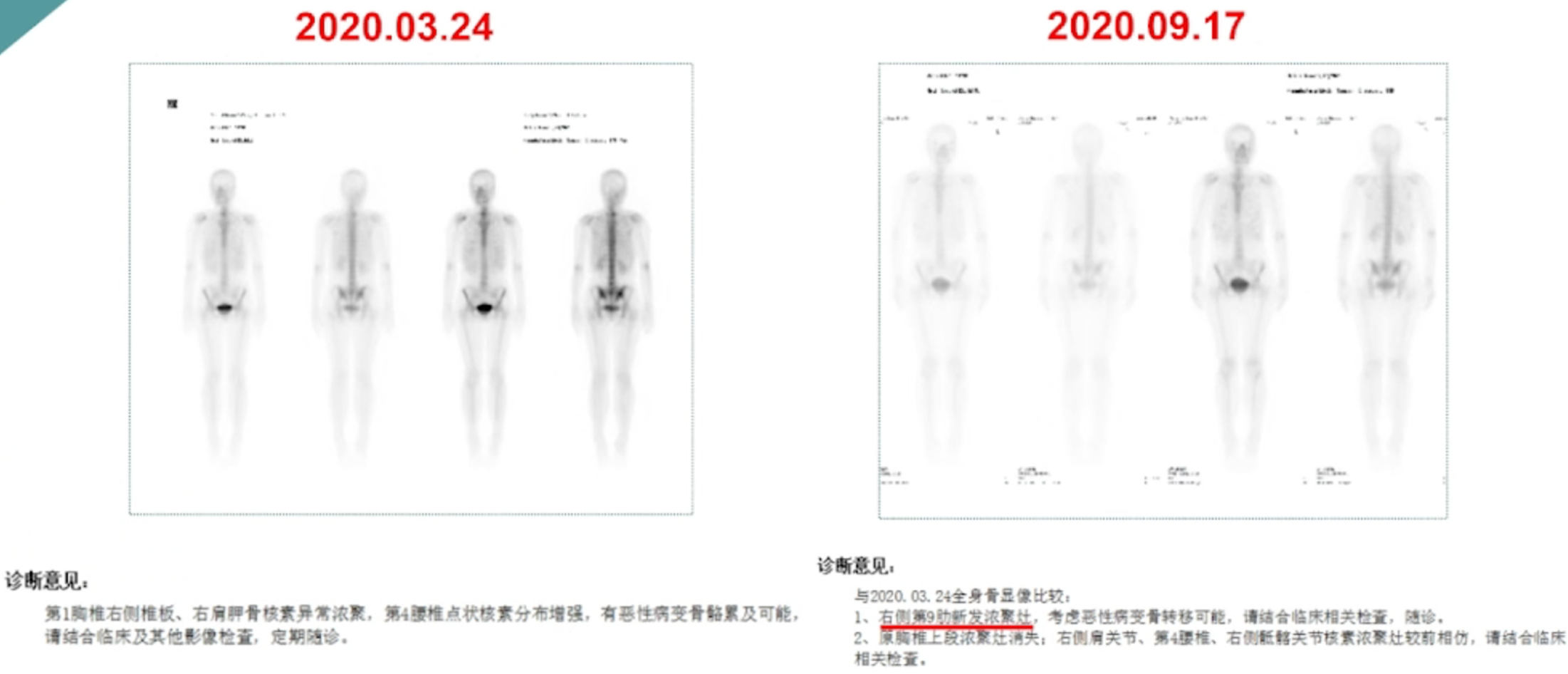 一线治疗后ECT检查结果.png