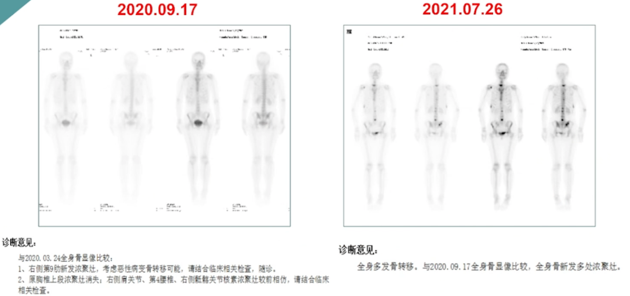 二线治疗后ECT检查.png