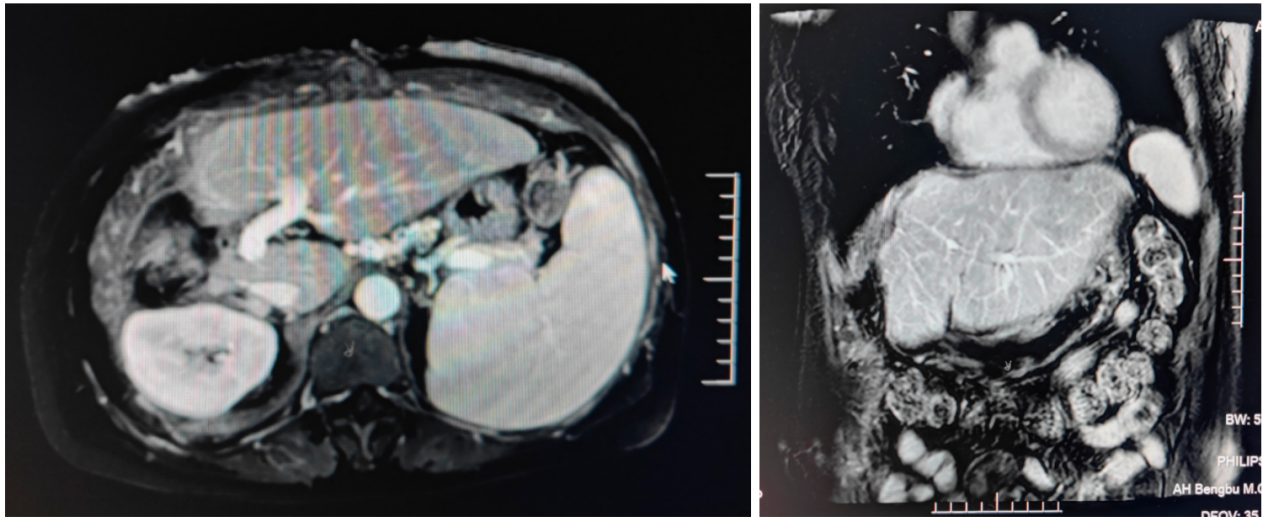 2023-07-10上腹部MRI平扫+增强影像.png