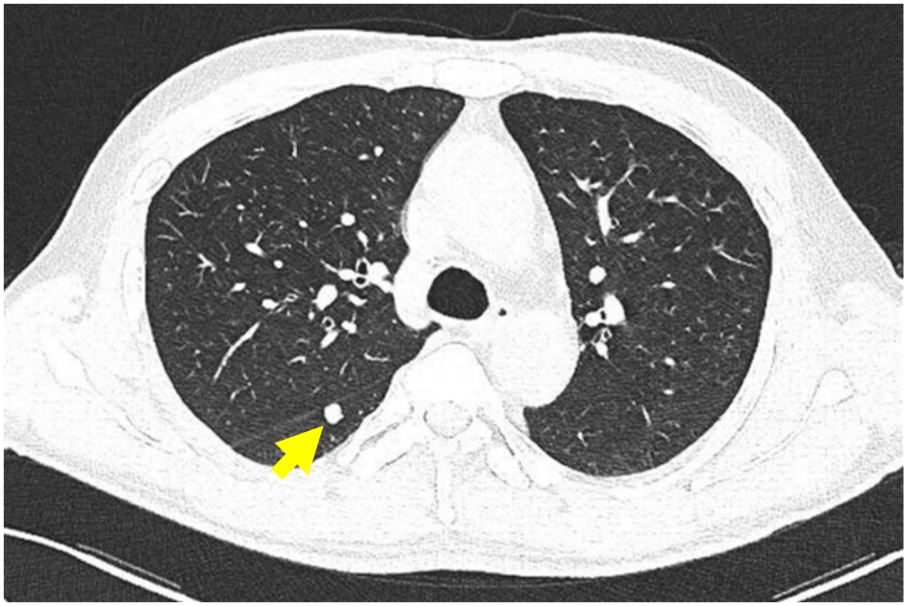 肺部CT.png