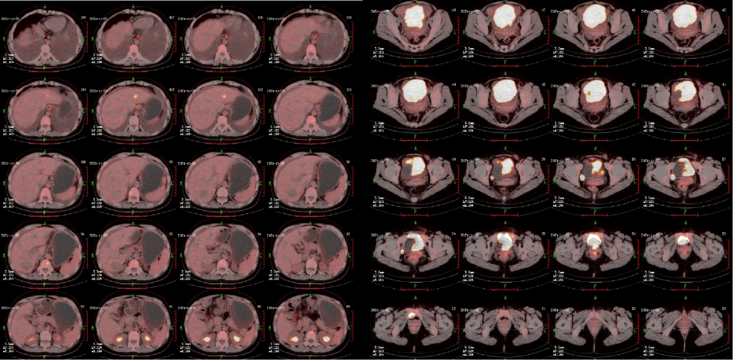 图3. PECT检查.png