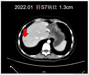 图4. 腹部CT检查（2022年1月15日）.png