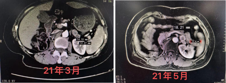 肾脏CT（左：2021年3月，右：2021年5月）.png