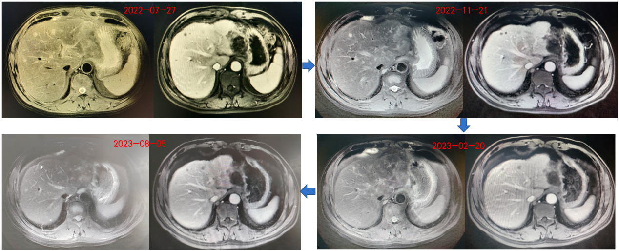 不同时间点肝脏MRI影像对比，见肿瘤一直维持SD状态.png