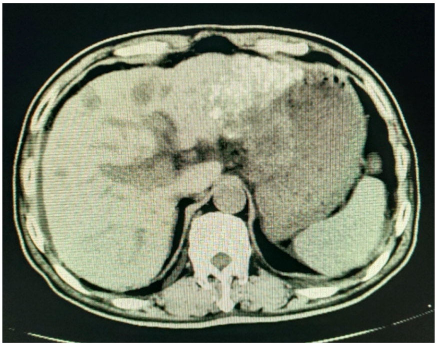 2022-04-06肝脏CT检查影像.png