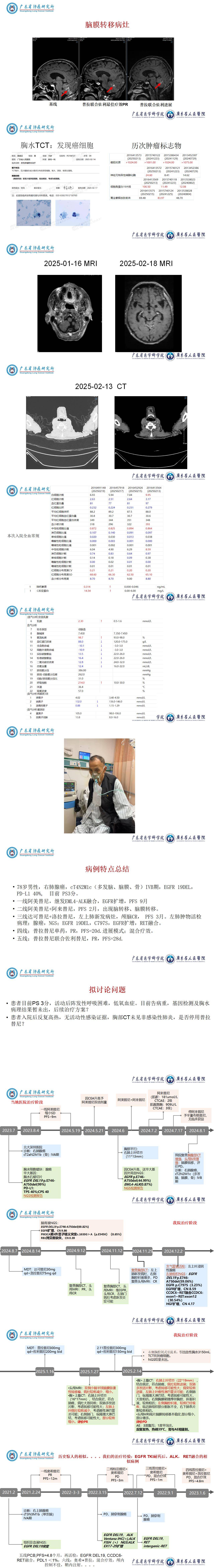 EGFR突变肺腺癌靶向耐药后获得性ALK、RET融合并脑膜转移的病例反馈-张一辰-肺内一科_02.jpg