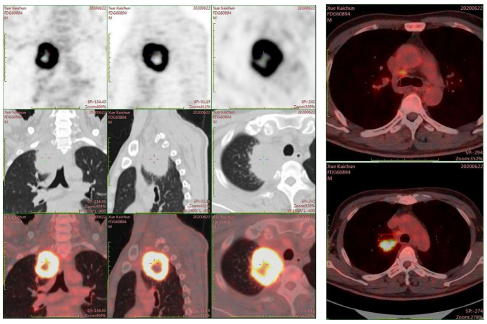 图1 PET-CT影像.png
