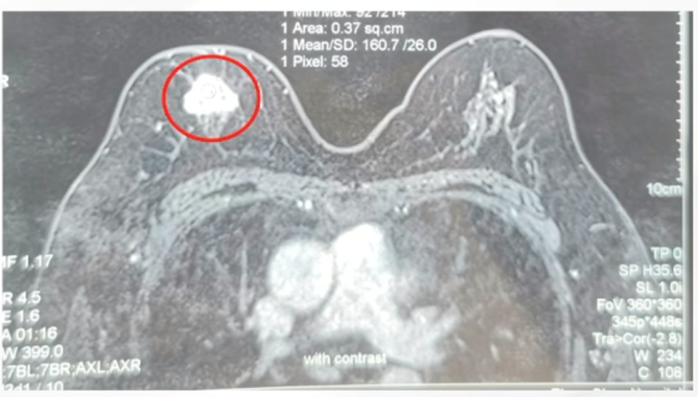 图1. 2019-02 乳腺MRI.png