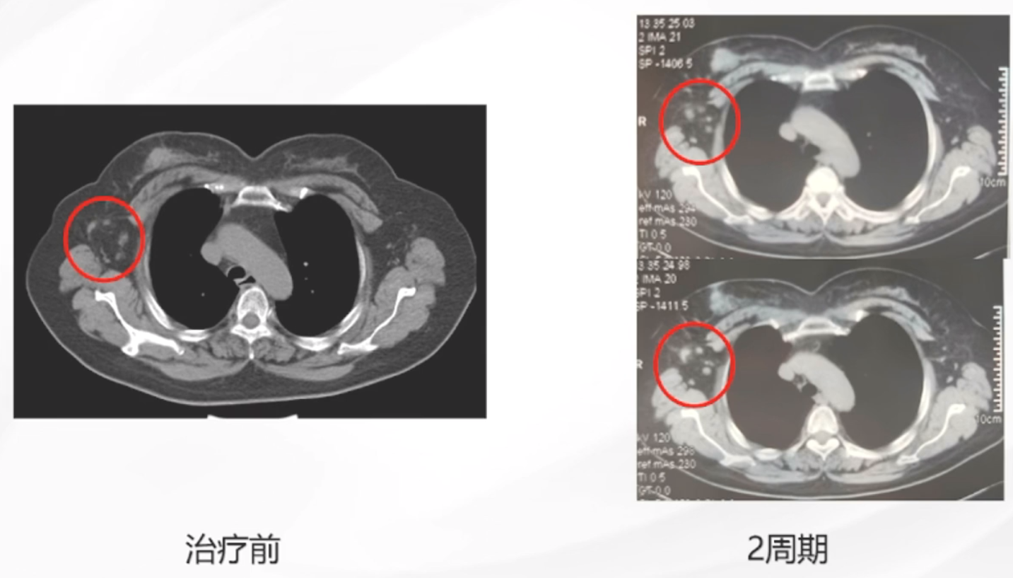 图4. 治疗2周期后疗效评估.png