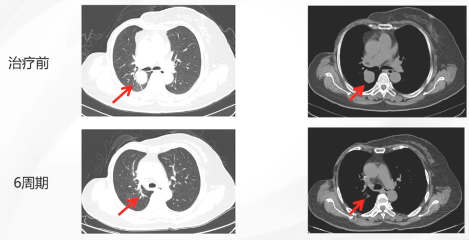 图7. 治疗6周期后疗效评估.png