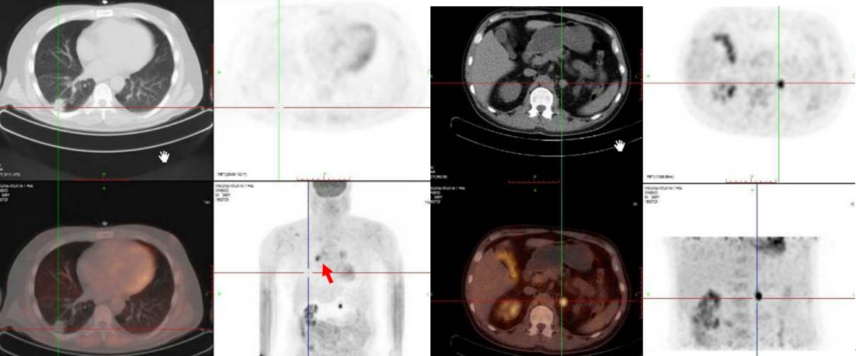 图 2021.03.08 PET-CT.png