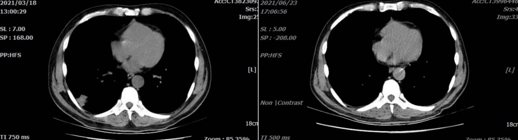 图 治疗前（左）与治疗3个月后（右）肺部CT检查疗效对比.png