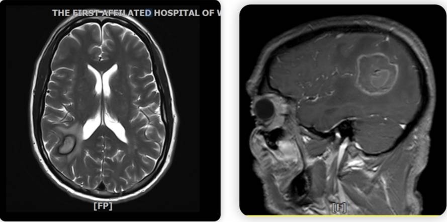 图 2023.11.27 MRI（左）与2023.12.25 MRI（右）.png