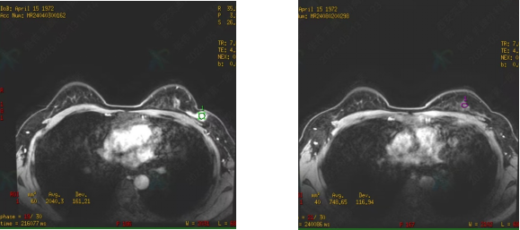 图2. 新辅助治疗后MRI.png