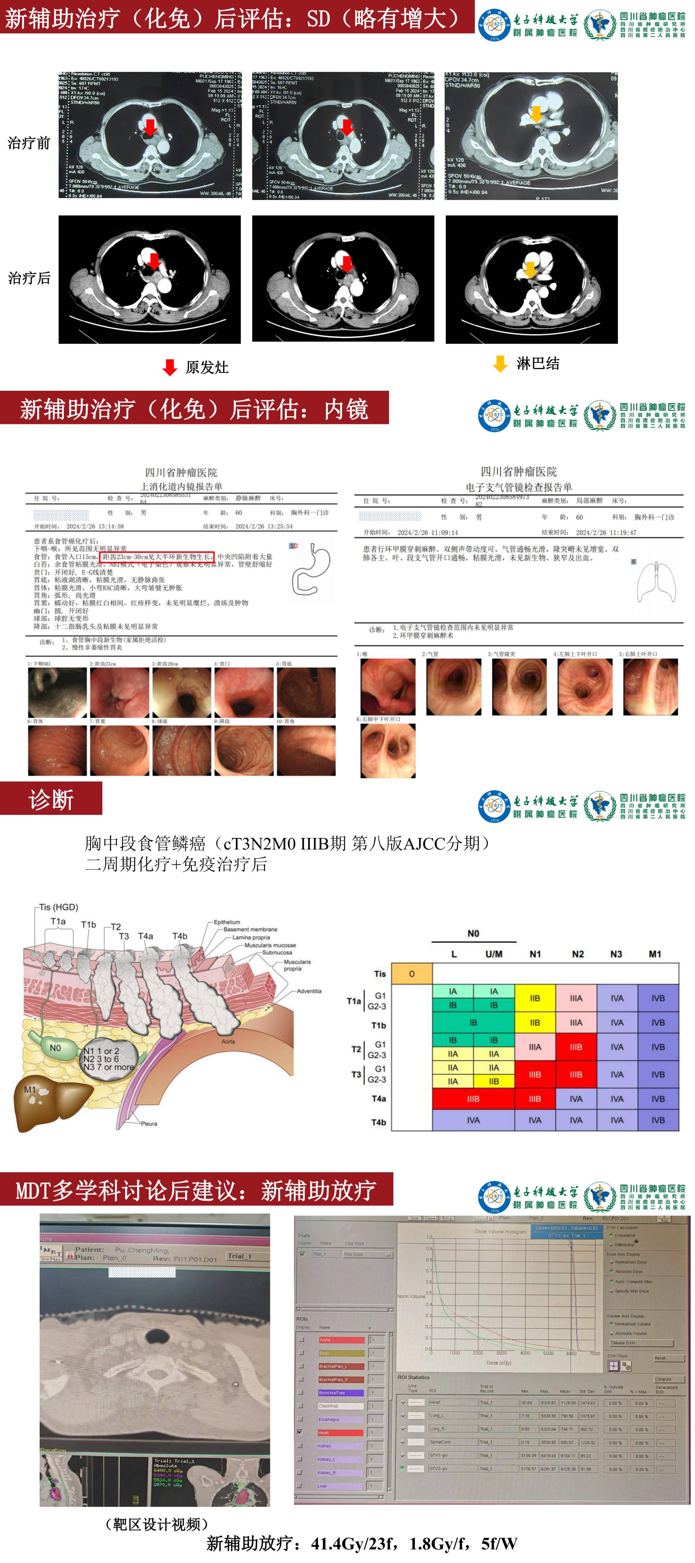 张欢 一例食管癌新辅助化免后补充放疗后行根治性手术的病例分享_00(2).jpg