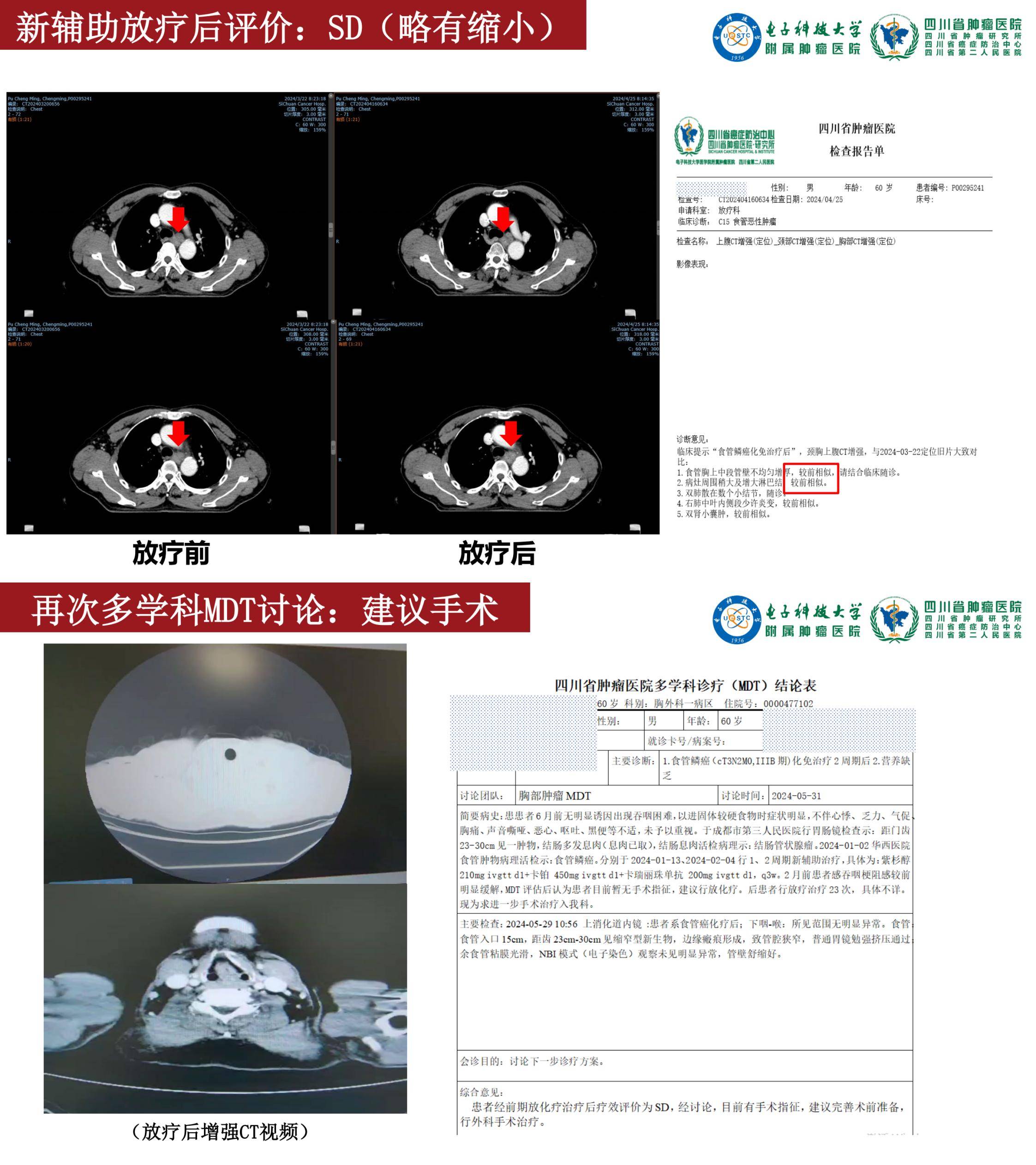 张欢 一例食管癌新辅助化免后补充放疗后行根治性手术的病例分享_00(3).jpg