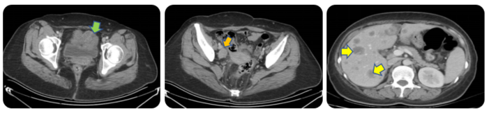 图1. 腹部CT检查(2023年1月28日).png 图1. 腹部CT检查(2023年1月28日).png