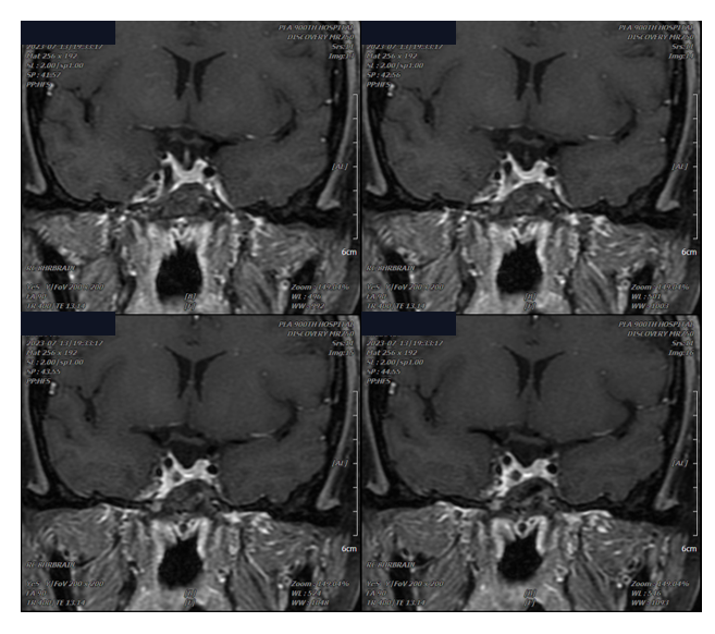 图:经规律SSA治疗后,肿块明显缩小。.png 图:经规律SSA治疗后,肿块明显缩小。.png