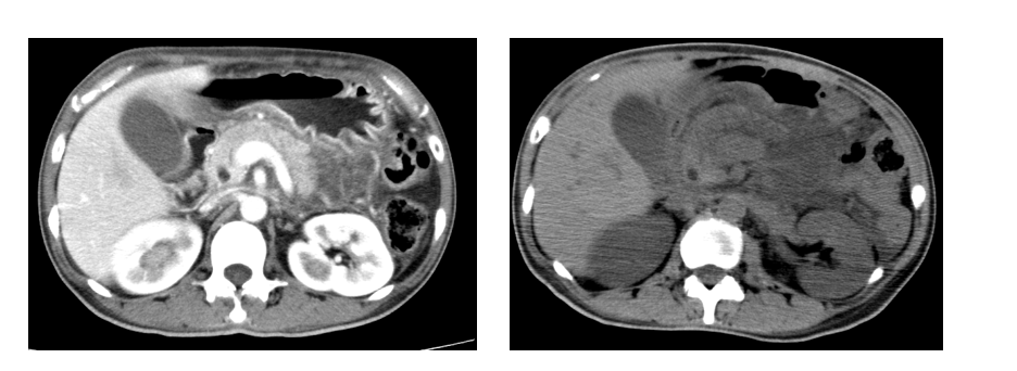图:胰腺CT平扫+增强.png 图:胰腺CT平扫+增强.png