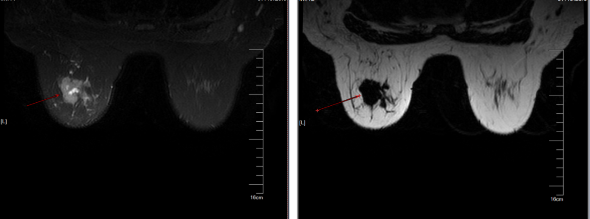图2 乳腺MRI.png