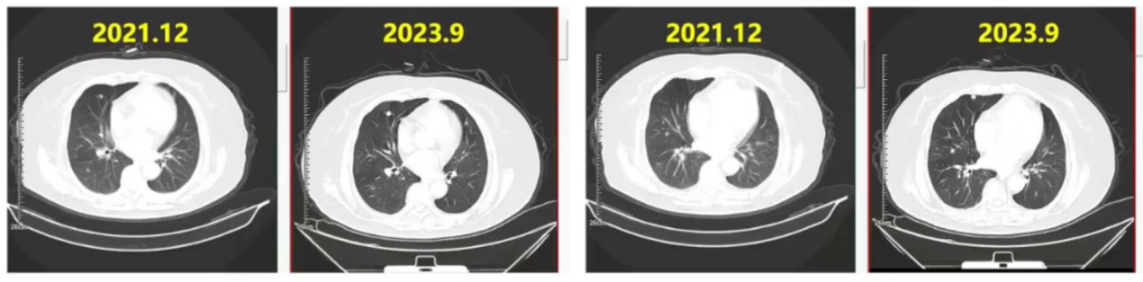 2023.9胸部CT.png