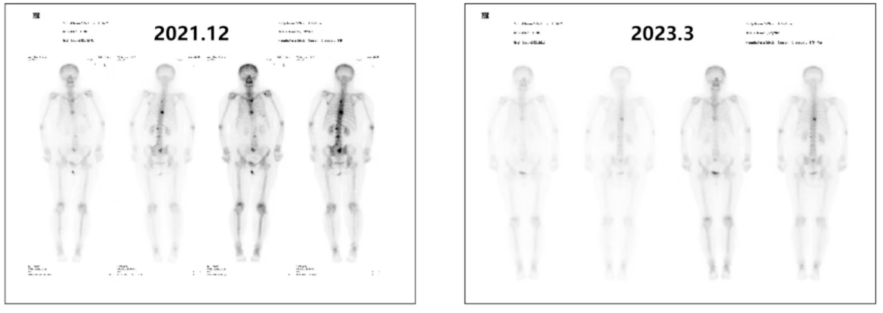 一线治疗期间骨显像检查.png
