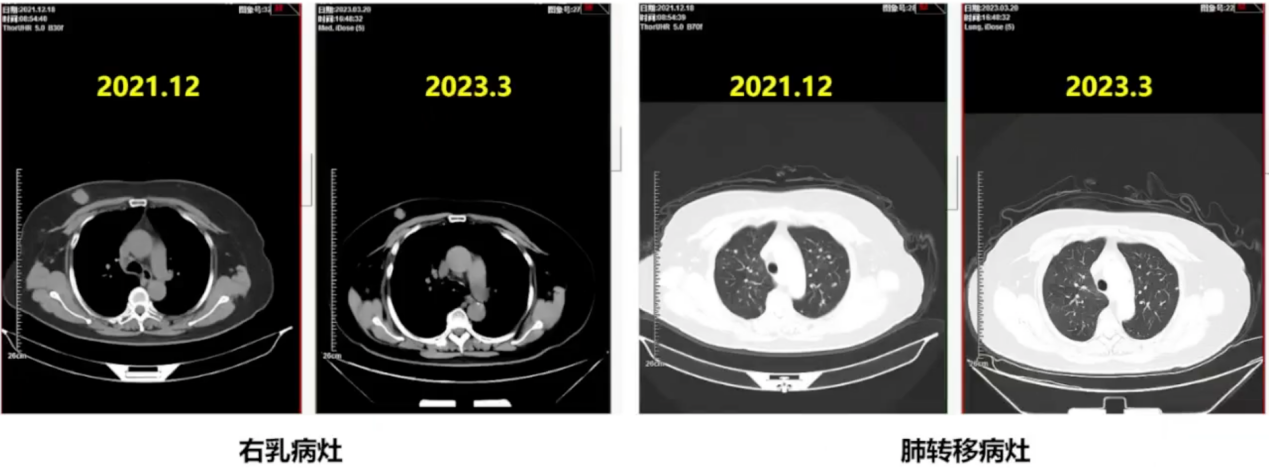 一线治疗期间CT检查.png