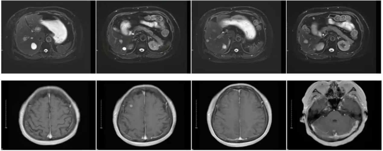 2024.3MRI检查：新发肝脏、颅内多发病灶.png