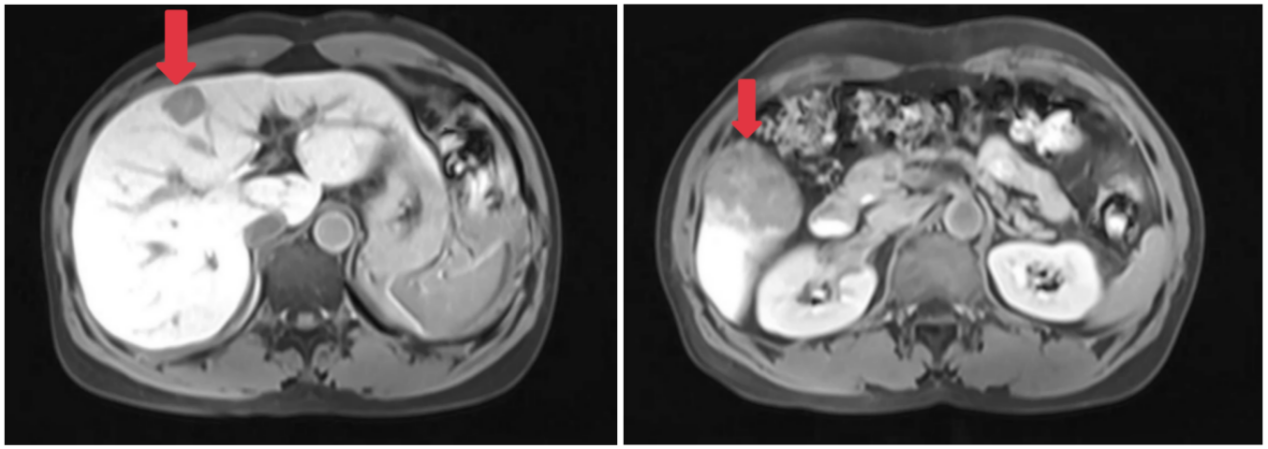 2019-03-05上腹部MRI影像.png