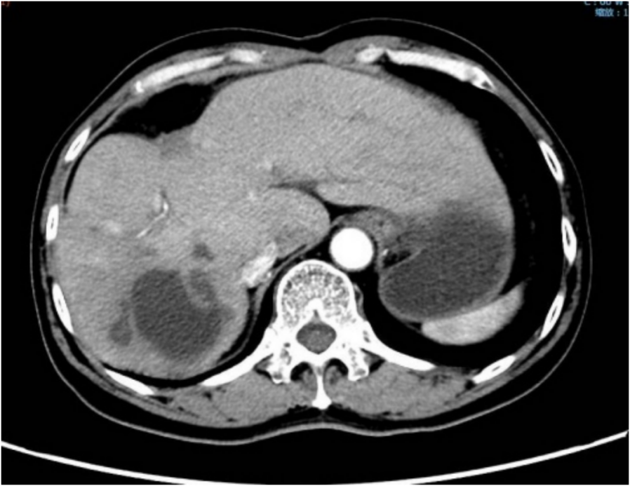 转化治疗后上腹部CT影像，见瘤灶明显缩小，对比转化治疗前达PR.png