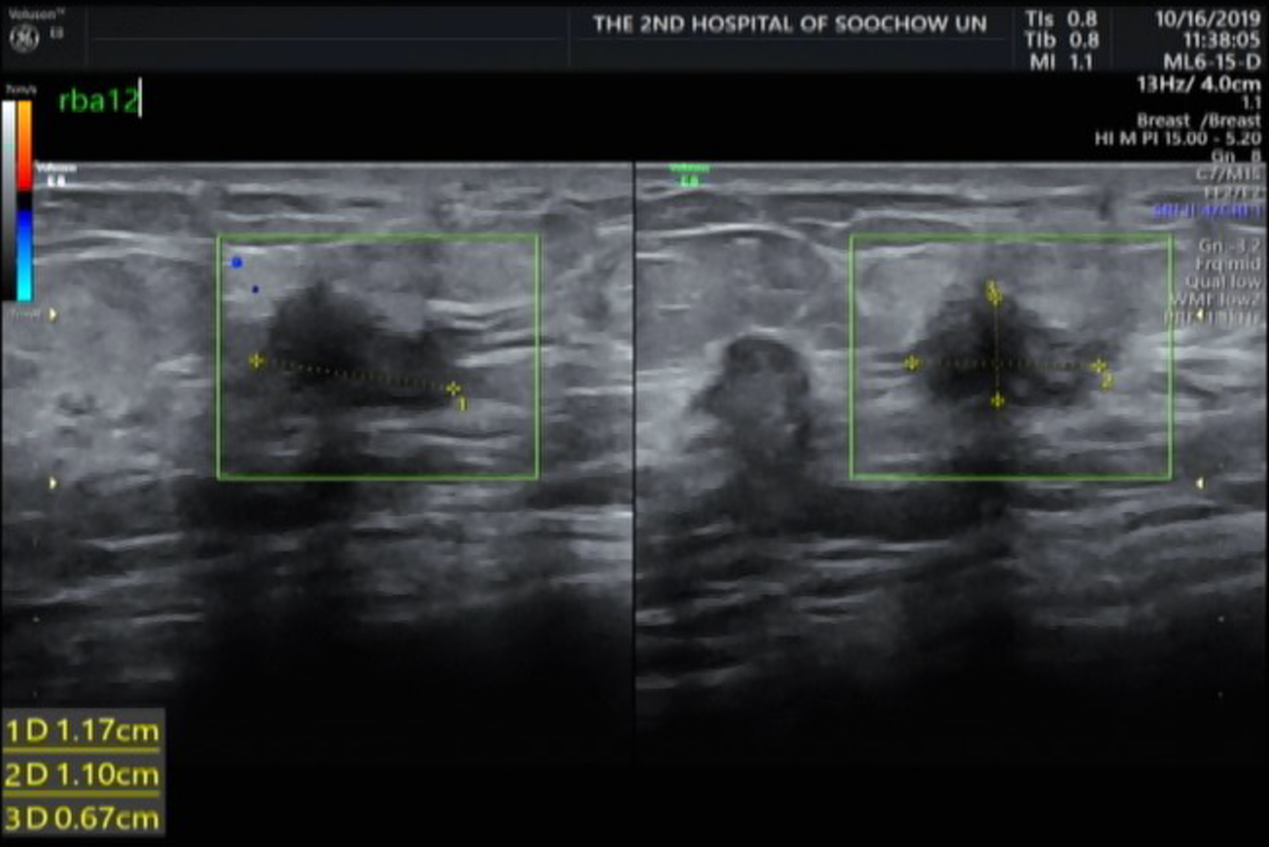 乳腺及腋窝淋巴结彩超（2019-10）.png