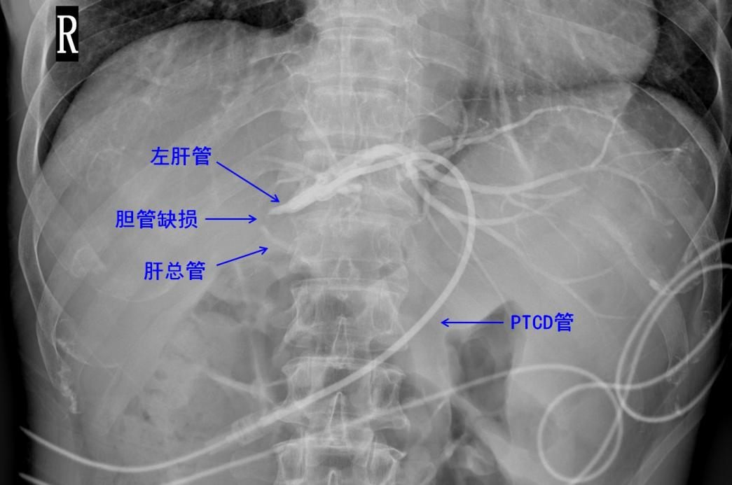 外院PTCD造影图像，见右肝管不显影，引流管置入左肝管.png