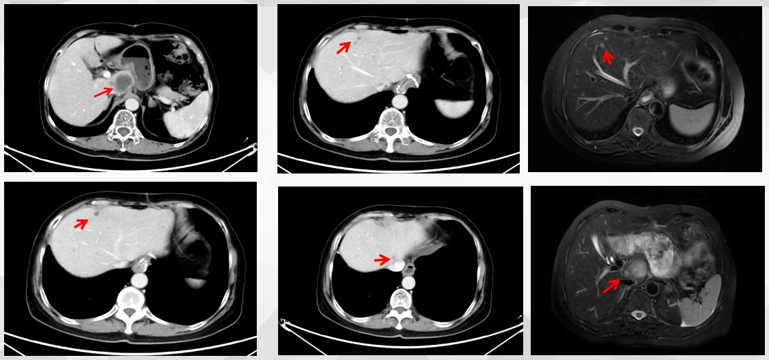 图1. 腹部CT检查（2023.3.14）.png