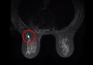左侧腋窝淋巴结呈逐渐缩小趋势，胸膜处病灶逐渐缩小。.png